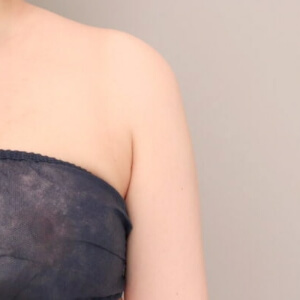 脇肉の脂肪吸引【術前／1ヶ月 31歳女性】の術後写真