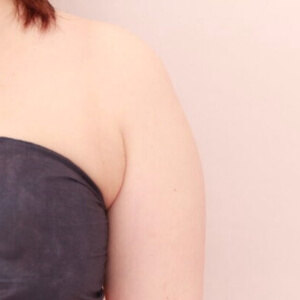 脇肉の脂肪吸引【術前／1ヶ月 31歳女性】の術前写真