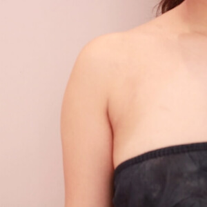 脇肉の脂肪吸引【術前／3ヶ月 23歳女性】の術前写真