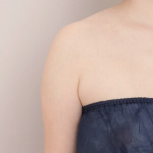 脇肉の脂肪吸引【術前／6ヶ月 30歳女性】の術前写真