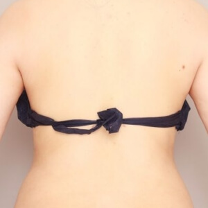 肩甲骨上下＋腰の脂肪吸引【術前／3ヶ月 27歳女性】