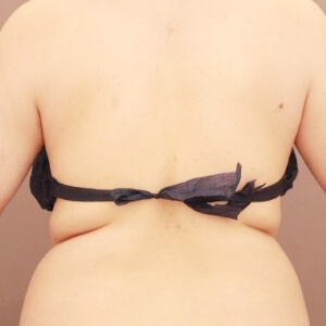 肩甲骨上下＋腰の脂肪吸引【術前／3ヶ月 27歳女性】