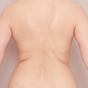 肩甲骨上下＋腰の脂肪吸引【術前／1ヶ月 54歳女性】の術前写真