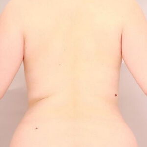 肩甲骨上下＋腰の脂肪吸引【術前／6ヶ月 25歳女性】の術前写真