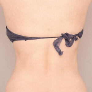 肩甲骨上下＋腰の脂肪吸引【術前／6ヶ月 44歳女性】の術後写真