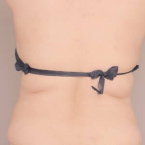 肩甲骨上下＋腰の脂肪吸引【術前／6ヶ月 44歳女性】の術前写真