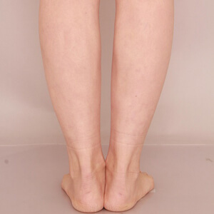 ふくらはぎ＋足首の脂肪吸引【術前／6ヶ月 38歳女性】の術後写真