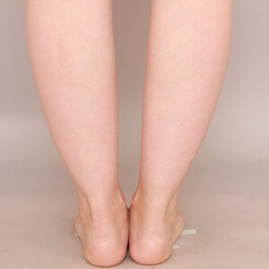 ふくらはぎ＋足首 の脂肪吸引【術前／6ヶ月 38歳女性】の術前写真