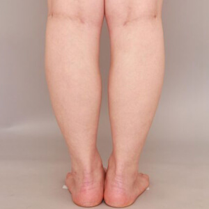 ふくらはぎ＋足首の脂肪吸引【術前／6ヶ月 28歳女性】の術後写真