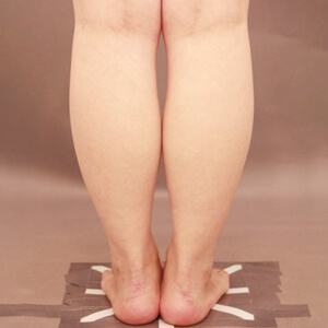 ふくらはぎ＋足首の脂肪吸引【術前／6ヶ月 28歳女性】の術前写真