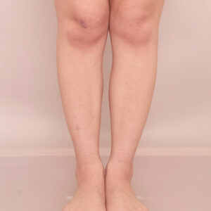 ふくらはぎ＋足首の脂肪吸引【術前／6ヶ月 25歳女性】の術後写真