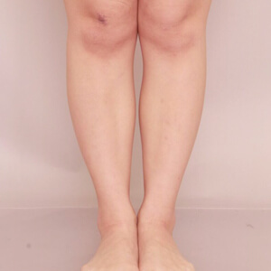ふくらはぎ＋足首の脂肪吸引【術前／6ヶ月 25歳女性】の術前写真