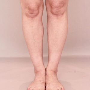 ふくらはぎ＋足首の脂肪吸引【術前／3ヶ月 42歳女性】の術後写真