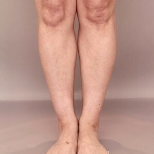 ふくらはぎ＋足首の脂肪吸引【術前／3ヶ月 42歳女性】の術前写真