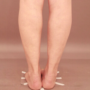 ふくらはぎ＋足首の脂肪吸引【術前／3ヶ月 47歳女性】の術後写真