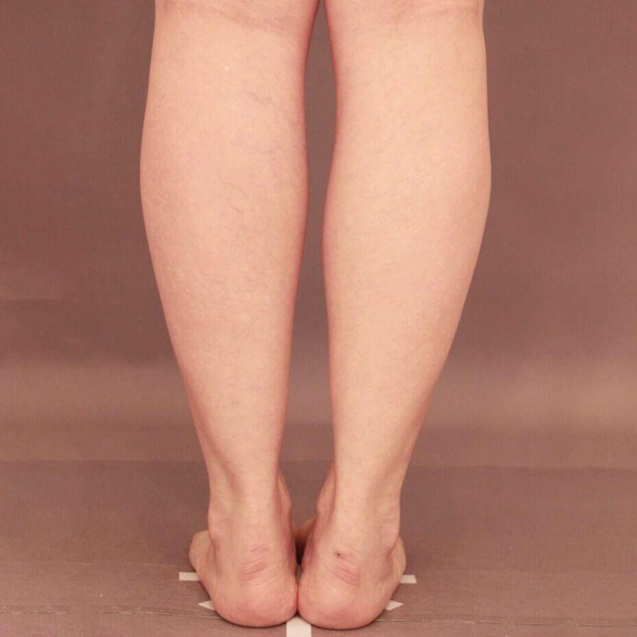 ふくらはぎ＋足首の脂肪吸引【術前／3ヶ月 47歳女性】の術前写真