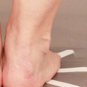 ふくらはぎ＋足首の脂肪吸引【術前／3ヶ月 35歳女性】の術後写真