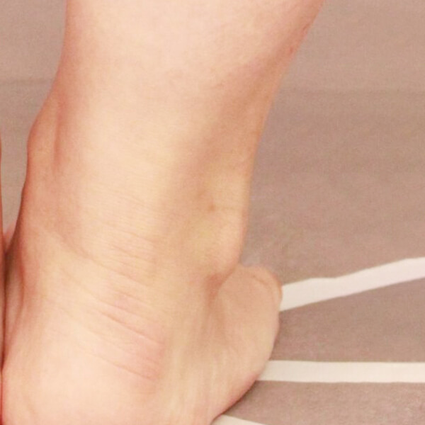 ふくらはぎ＋足首の脂肪吸引【術前／3ヶ月 35歳女性】の術前写真