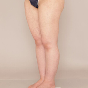 太もも全周＋ふくらはぎ＋足首の脂肪吸引【術前／1ヶ月 27歳女性】の術後写真