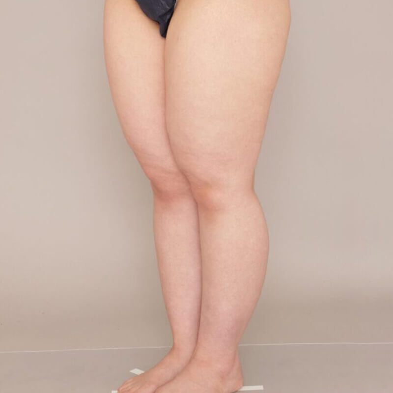 太もも全周＋ふくらはぎ＋足首の脂肪吸引【術前／1ヶ月 27歳女性】の術前写真
