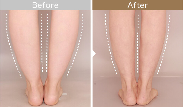 ふくらはぎ：サイドまで回り込んで吸引