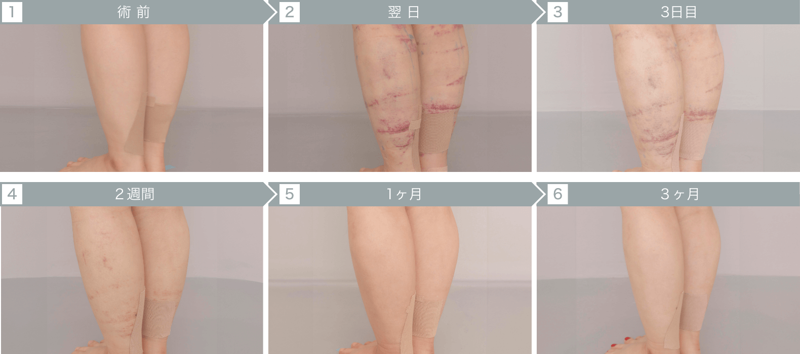 ふくらはぎ・足首の脂肪吸引のダウンタイム