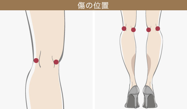 ふくらはぎの脂肪吸引の傷跡