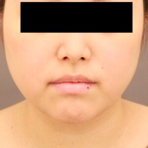 顔（頬・顎下）の脂肪吸引【術前／6ヶ月 27歳女性】の術前写真