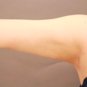 二の腕の脂肪吸引【術前／6ヶ月 30歳女性】の術後写真