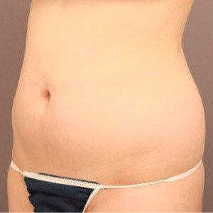 お腹・腰の脂肪吸引【術前／6ヶ月 29歳女性】の術前写真