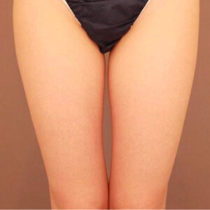 太ももの脂肪吸引【術前／6ヶ月 34歳女性】の術前写真
