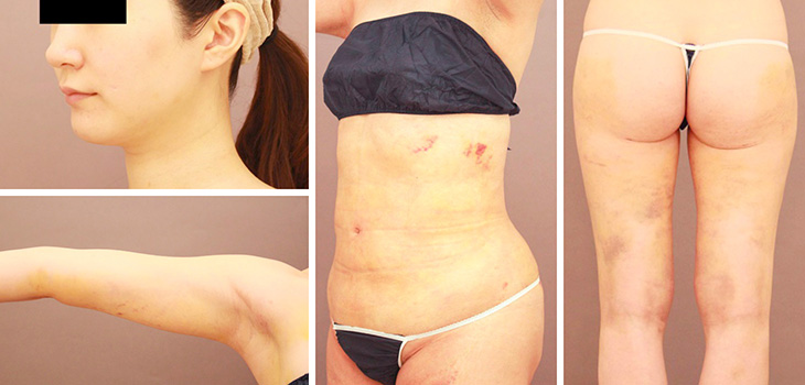 術後1週間の様子