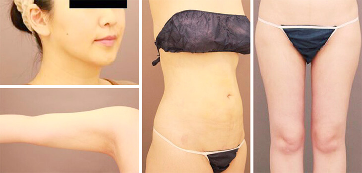 術後1ヶ月の様子