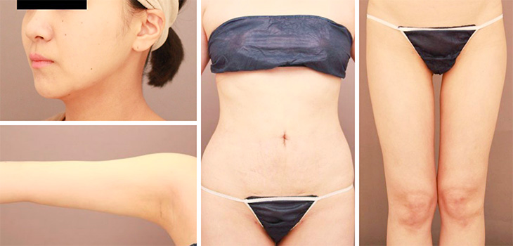 術後3ヶ月の様子