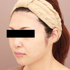 顔（頬・顎下）の脂肪吸引【術前／3ヶ月 36歳女性】の術後写真