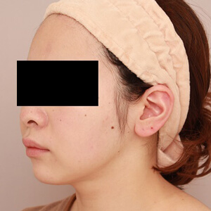 顔（頬・顎下）の脂肪吸引【術前／3ヶ月 25歳女性】の術後写真