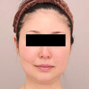 顔（頬・顎下）の脂肪吸引【術前／1ヶ月 46歳女性】の術前写真