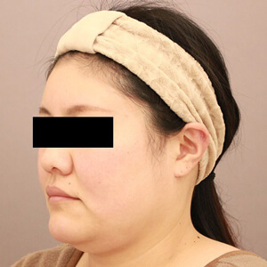 顔 頬 顎下 の脂肪吸引 Mods Clinic モッズクリニック 公式 東京 銀座 大阪 名古屋 福岡