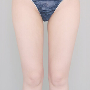太もも＋膝＋お尻の脂肪吸引【術前／6ヶ月 24歳女性】の術後写真