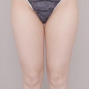 太もも＋膝＋お尻の脂肪吸引【術前／6ヶ月 24歳女性】の術前写真