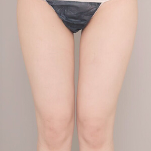 太もも＋膝＋お尻の脂肪吸引【術前／2ヶ月 27歳女性】の術後写真