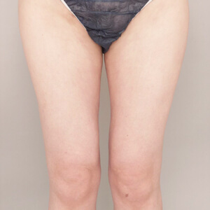 太もも＋膝＋お尻の脂肪吸引【術前／3ヶ月 30歳女性】の術後写真