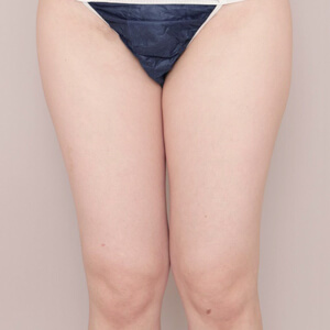 太もも＋膝＋お尻の脂肪吸引【術前／3ヶ月 30歳女性】の術前写真