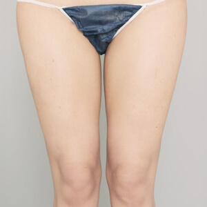 太もも＋膝＋お尻の脂肪吸引【術前／3ヶ月 21歳女性】の術後写真