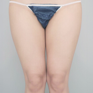 太もも＋膝＋お尻の脂肪吸引【術前／3ヶ月 21歳女性】の術前写真
