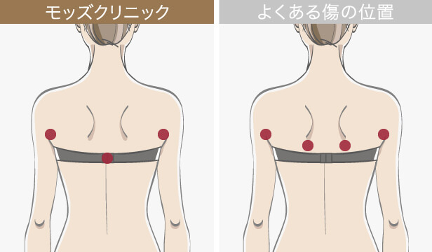 モッズクリニックの背中の脂肪吸引の傷の位置