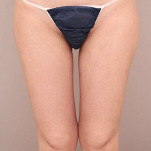 太もも全周＋お尻の脂肪吸引【術前／1ヶ月 40歳女性】の術後写真