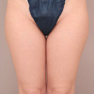 太もも全周＋お尻 の脂肪吸引【術前／1ヶ月 40歳女性】の術前写真