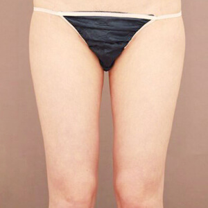 太もも全周＋お尻の脂肪吸引【術前／6ヶ月 21歳女性】の術後写真