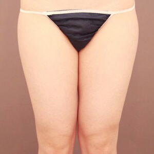 太もも全周＋お尻の脂肪吸引【術前／6ヶ月 21歳女性】の術前写真